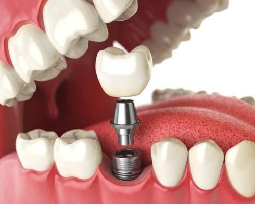 IMPLANTE DENTÁRIO